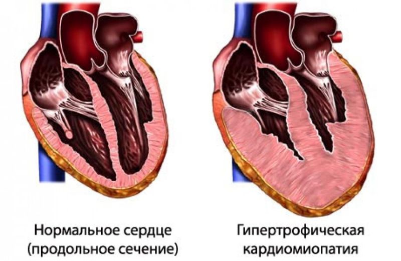 Гипертрофическая кардиомиопатия у кошек